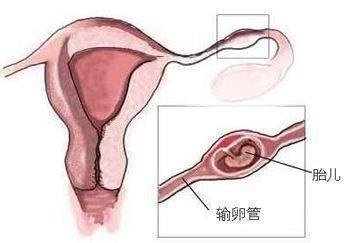 一代试管婴儿比二代试管婴儿好吗,妊娠率有差异吗