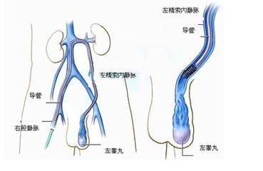 子宫内膜多少才算厚？子宫内膜过厚需要进行宫腔镜医治吗