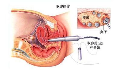 少精子症可以直接二代试管婴儿吗