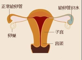 试管婴儿促排卵药物安全吗