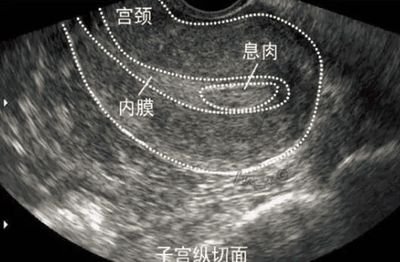 早发性卵巢功用不全还能试管婴儿怀孕吗
