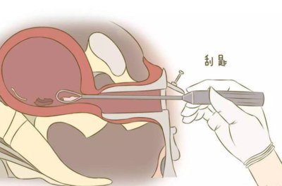 得过宫外孕做试管婴儿有影响吗