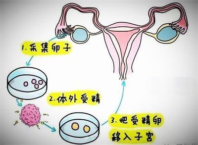 女性不孕之排卵障碍：试管婴儿助孕是否可行？