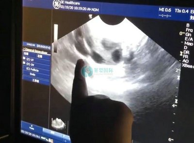 深圳试管婴儿移植几天着床