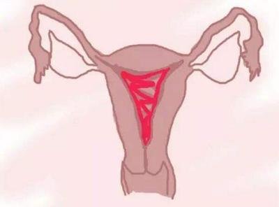 宫腔粘连能做深圳试管婴儿吗？