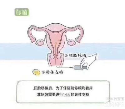 试管婴儿胚胎移植后准妈妈要关注哪些方面